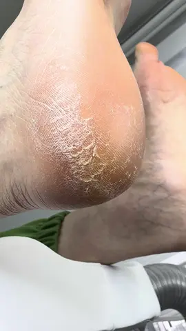 Check out this amazing before and after transformation of cracked heels! Witness the step-by-step process of turning rough, dry heels into smooth, healthy skin. Perfect for anyone looking for effective foot care tips. Don't miss this satisfying transformation! #pedicure #istanbul satisfying #podology #footcare