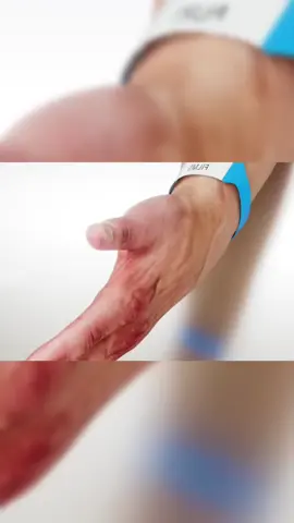 In this video we discuss the possibilities of recovery after the accidental loss of a hand or amputation of the knee. In the case of the hand, if the blood vessels and nerves remain intact and there is a fresh hand donation available, it is possible to successfully perform a transplant, restoring the normal function of the hand. For knee amputations, doctors can preserve the main blood vessels and nerves by cutting the central part of the thigh and then grafting the remaining lower leg into the thigh, turning the ankle into a functional knee joint. Although these procedures may seem unusual, they offer hope and functionality to those who face such challenges. #foryou #foru #fyp #4u #foryoupage #fypage #fouryou #fouryoupage #usa #uk #us #medicine #recuperacion #knowledge #knowledgesharing #curiosity 