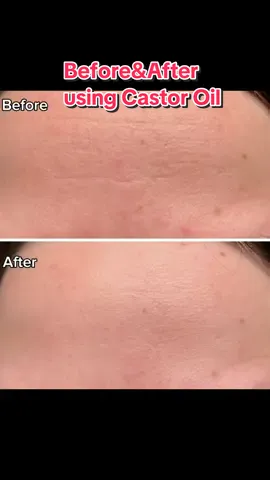 Castor Oil saved my skin🥹 #castoroil#skincare#skincaretips#skincareroutine#SkinCare101#naturalskincare#skincareviral#BeautyTok  