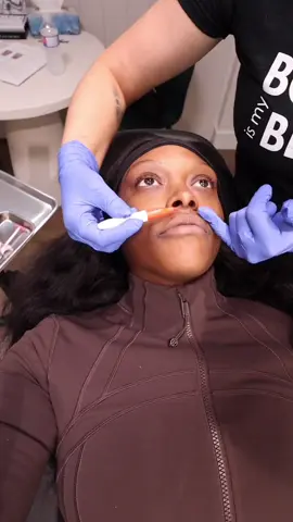 Getting lip injections for the first time as a 25 year old black girl was QUITE the experience! I went to @subtleenhancements after going back and forth between getting my lips done or not getting my lips done and have NO REGRETS. I never ever thought I'd actually go through with getting lip injections but here we are!!! #firsttimelipfiller#lipfiller #injections #dermalfiller #lipinjection #lipenhacement #nurseinjector #blackgirlfillers#lipfillerblackgirl #lipdissolving #lipflip #injectorsontiktok #cosmeticprocedures