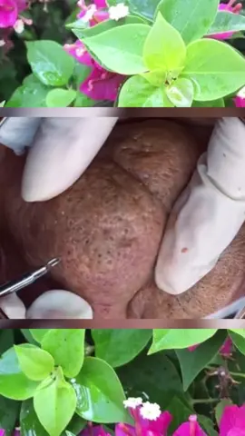 #squeeze #squeezeyuk #acne #pimple #pimplepop #blackhead #satisfying #foryoupage