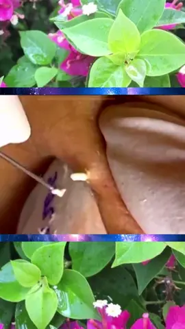 #squeeze #squeezeyuk #acne #pimple #pimplepop #blackhead #satisfying #foryoupage