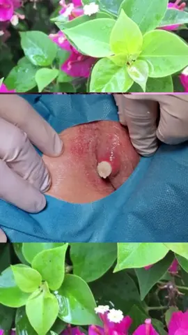 #squeeze #squeezeyuk #acne #pimple #pimplepop #blackhead #satisfying #foryoupage
