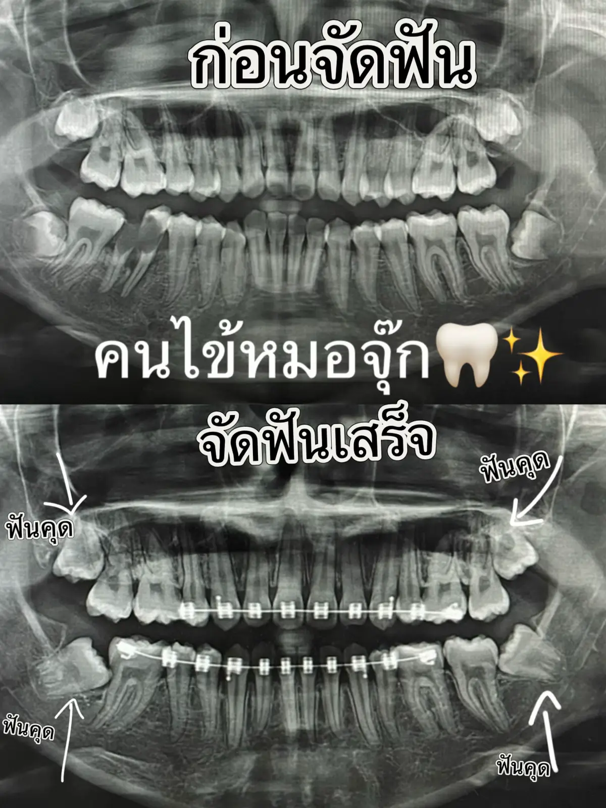 คนไข้จัดฟัน หมอจุ๊กค่ะ #จัดฟัน #คลินิกหมอจุ๊ก #ยาสีฟันวีไวน์ #ฟันยื่น 