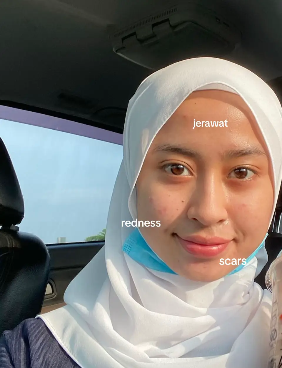 Dari dulu struggle , kadang tu skin teruk cuma tak de gambar je masa breakout 2022 😭 !! Memang ambik masa gila nak okay.. try and error banyak product! Tapi kalini janji tak tukar dah 🥰♾️♾️ paling penting kena cari pelembab yang sesuai!  Korang boleh cuba tapi kena ingat skin kita lain lain ye! 💗 #originotemoisturizer #originote #fyp #foryoupage #acne 