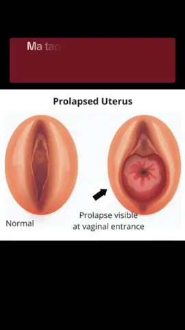 Pelvic organ prolapse (uterine prolapse)#doctors #gyno #somaligirls 