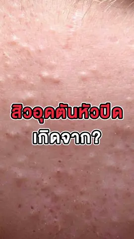 สิวอุดตันหัวปิด เกิดจากอะไร⁉️  #สกินแคร์ #บอกต่อของดี #สิว #สิวอุดตัน #amtliposomeserum #amtskincare #tiktokshopmidmonthsale #ช้อปมันส์กลางเดือน #fyp 