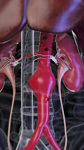 🚨 Could you recognize an Abdominal Aortic Aneurysm Rupture? 🚨 Knowing what to look for could save a life: sudden pain, pulsating navel. Quick tips on what you need to know! #HealthTips #SaveLives #SciePro #EduTikTok #science #3d #animation #vray #science #sciart #medart #medical #meded #education #health #autodesk #3dsmax #medstudent #study