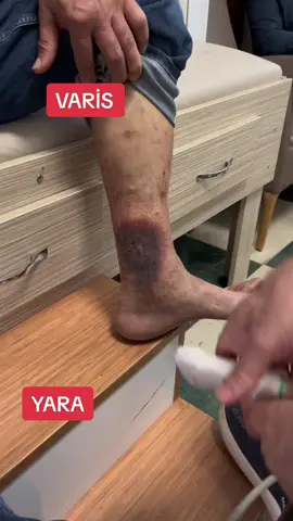 VARİS. YARA. Ayakta yada oturarak uzun süre sabit duranlarda varis oluşma ihtimali yüksektir.  Ana toplardamarlar sağlam olduğu halde, yüzeyel toplardamar ile derin toplardamar arasında köprü vazifesi gören perforan venlerde bozulma olabilir.  Bu anormallik ayrıntılı venöz doppler ultrasonografi yapılarak tespit edilir. Yoğun iş temposundan zaman kısıtlılığından dolayı radyoloji bölümününde bu patolojiyi tespit etmeye zaman olmayabilir.  Ancak klinisyenler yani biz kalp damar cerrahisi uzmanları yeterince vakit ayırırsak ayrıntılı doppler ultrasonografi yaparak bu anormalliği tespit edebiliriz.  Perforan ven yetmezliği tespit edilmiş ise tedavisi ligasyondur. Yani kaçak ortadan kaldırılmalıdır.  Perforan ven yetmezliği tedavi edilmez ise bacaklarda ve ayak bileklerinde şişlik ve kahverengi siyah cild renk değişikliği oluşturur.  Tedavi hala edilmez ise bu bölgelerde yara açılır.  Dostlarımıza öneri; varisiniz var ise yeterince zaman ayrılarak ayrıntılı venöz doppler ultrasonografi yaptırabileceğiniz bir kalp damar cerrahisi uzmanına başvurunuz. Hem teşhis konur hemde tedaviniz yapılır.  İletişim Tel: 0553 8475688 Grandmedical Hospital  https://www.instagram.com/doc.dr.ademguler/ #kapalıbypass #kalpdamar  #kalpdamarcerrahisi #kalpcerrahisi #kalpvedamarcerrahisi #kalphastalıkları #kalpdamarsağlığı #kalpkrizi #kalpsağlığı #kalpsagligi #varis #varisameliyatı #varistedavisi #ameliyatsızvaristedavisi #kılcalvaristedavisi #kılcaldamartedavisi #kılcaldamar #koroner #aort #damartıkanıklığı #damarcerrahisi #kesfet #reels #anevrizma #anjio 