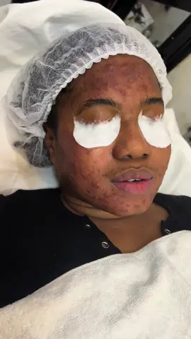 Vous avez des taches et des boutons des imperfections sur le visage alors c'est le moment ou jamais de prendre rendez-vous chez spa feeling séduction histoire de traiter cela avant la fête 🥳 Laissez-vous tenter par nos soins complet anti imperfections accompagner par des Pack anti-taches / anti-boutons et ses 3 produits essentiels. La routine idéale et efficace pour traiter taches et boutons à la fois dès les premières jour d'utilisation !n'attendez plus#alaune #senegalaise_tik_tok🇸🇳pourtoichallenge #tendance #beaut #spa #feelingseductionbymari1 #pourtoi 