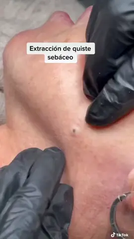 #limpiezas #extractions #extracciones #squeeze #acne #pimple #satisfaccion #satisfying #satisfaction #pimples #blackhead #blackheads #puntosnegros #espinillas #espinillasypuntosnegros #pop #pimplepop #acneremoval #granos #grains #poros #pimpleremover #pimpleremoval #pimpleremove #clean #cleaning #CleanTok #SkinCare #relax #relaxingvideos #relaxing #popper #popperpimple #limpiezafacial#popper #viral#facial #flamentossebaceos #grano #granos #grains #limpiezafacial #estetik #relax #foryou#nariz #fyp #viral #limpiezafacial #popper #like #granosyespinillas #pimplepop#pimpleremover #removal#ingrow #ingrownhair #hair #dentist #dentista #calculus #wax #earwax #confort #comfortable #comfort#white #whiteheads 