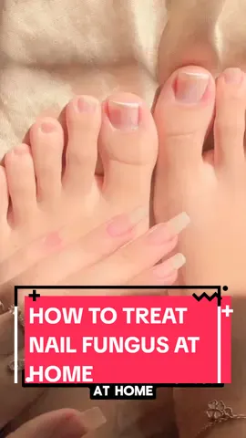 How to treat nail fungus at home #nailfungus #nailfungustreatment #nails #naturalrecipe 