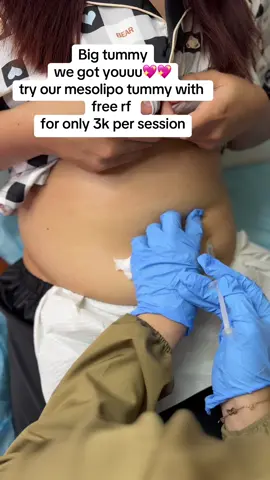 mesolipo tummy for only 3,000 per session #onthisday #fypシ #fyp #hikonoselift #nosefillers #whitening #botox #barbiearms #slimming #glutathione #skincare #skinoptionsaesthetics 