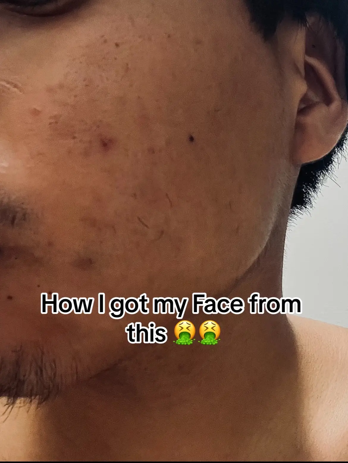 This is the Only way To Get Clearn Skin fast and cheap Korean Skincare is the best way to get clear skin super fast #creatorsearchinsights  #skincare  #korean  #koreanskincare  #clearskin  #cleanser  #trending  #viral 
