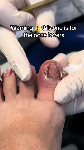 Tag your ooze lover friends!! #drdolz #ingrowntoenail #fyp #feet #satisfying 