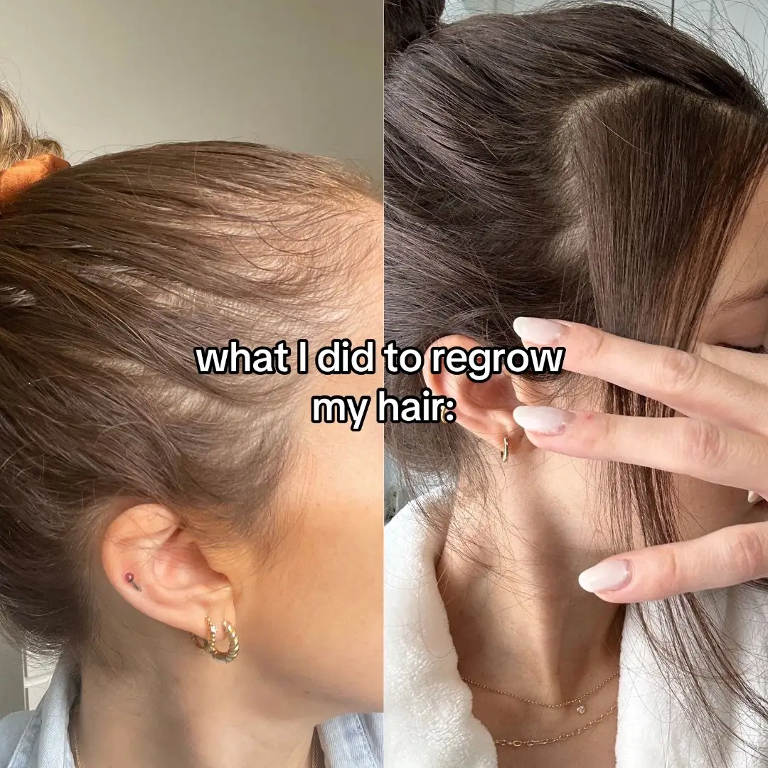 It took me a while to find what works for me, I’m so happy to be able to help you with your hair growth journey🌱🫶🏼 #TikTokShop #hairgrowth #scalpoil #rosemaryoil #hairloss #hairtok #hairtransformation #scalpoiling #hairoil 