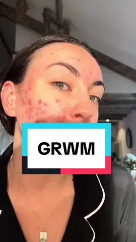 Been asked a few times about how i cover my acne, i am no make up artist at all but this is how i do it 🫶  #grwm #morningroutine #acne #makeuptutorial #MakeupRoutine @Maybelline New York @BIOSSANCE @got2b @L’Oréal Paris @Revolution Skin & Hair @e.l.f. Cosmetics 