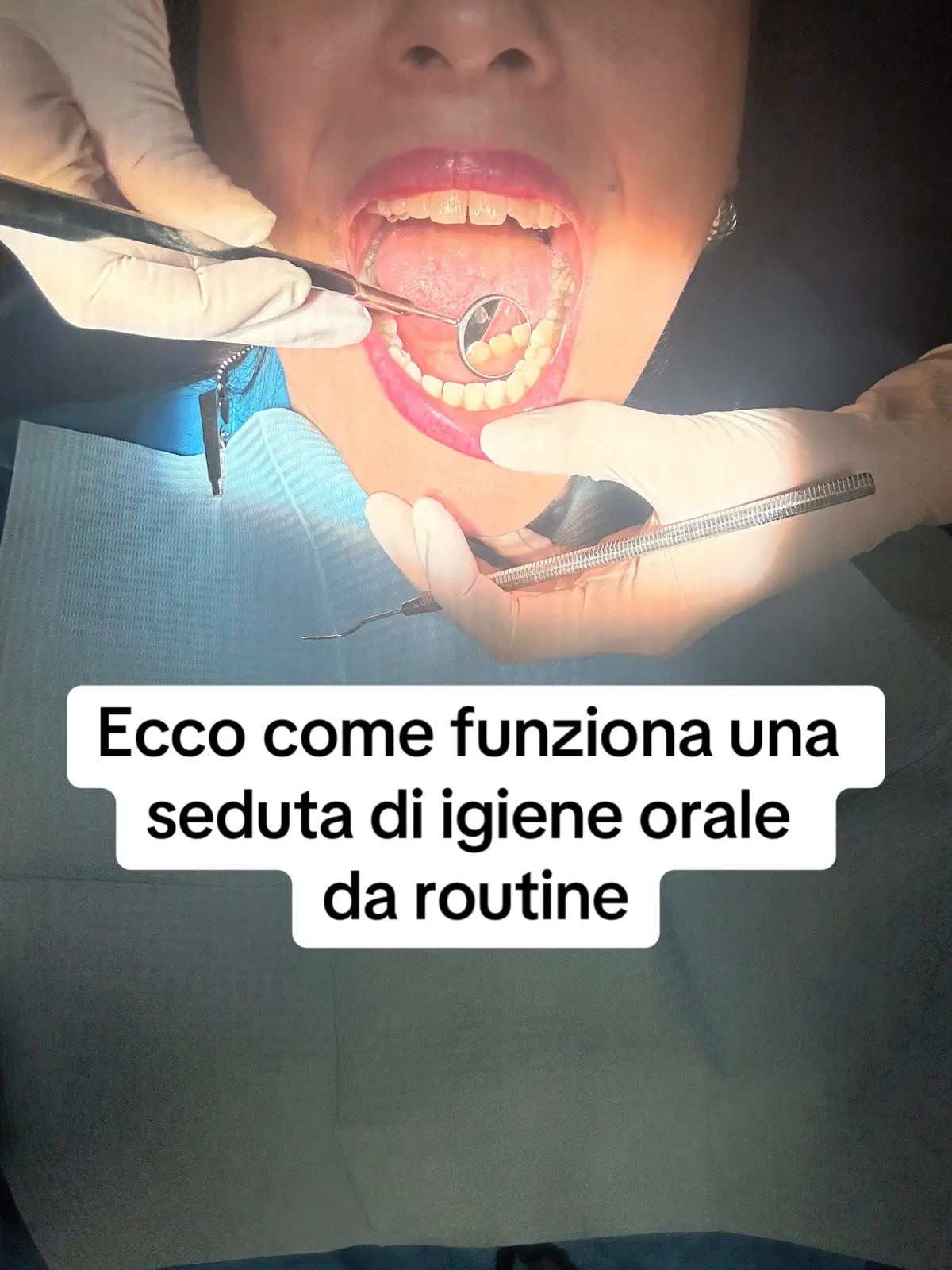 #placcadentale #tartarodental #fluoro #igieneorale #puliziadenti #puliziadentale #dentista #dentistasiracusa #daldentista #igienistadentale #ablazionetartaro 