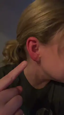 What is happening? Red, hot, burning ear. I genuinely feel like I’m subtly falling apart (but not so subtle to me) #redears #whatisthis #healthcondition #fallingapart #earproblems #somethingswrong 
