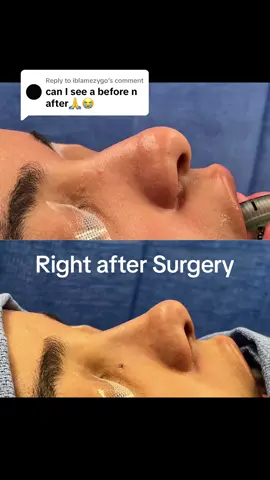 Replying to @iblamezygo sure! ☺️ It was a closed procedure (no outside incisions) and the goal was to keep it natural, while also eliminating my droopy tip that bothered me a lot when I smiled in my side profile! I did it back in 2022