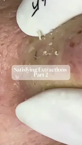 Getting rid of impurities, one extraction at a time! 💪 #facial #facialtreatment #skincare #relaxing #asmrfacial #fyp #knoxvilletennessee #backbay #boston #newburystreet 