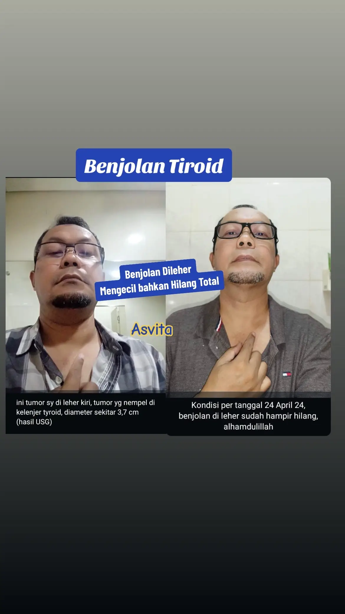 TUMOR KELENJER TIROID Tumor di kelenjar tiroid menyiksa.  Sakit, tidur ga nyenyak dan tersiksa Januari 2024 pak fairid harus melawan tumor yg sudah sah dinyatakan di lab, 3.7cm ada di kelenjar tiroid di leher.  Alhamdulillah ketemu dengan AFC  Konsumsi AFC April 2024 mengecil drastis  Dan alhamdulillah semakin membaik dan beliau langsung bercerita di seminar kami di bogor juni 2024  Harapan selalu ada bagi yang berusaha,  Terima kasih Allah  Terima kasih AFC  Sebarkan berita baik ini, Banyak yg butuh AFC, Bisa jadi teman kita, keluarga kita  Ataupun kita sendiri Konsultasi & Pemesanan di 📞0878.6888.5898 #subarashi  #hipertiroid  #testimonikesehatan  #sorotan  #hargaresmisubarashii  #sehatdenganafc  #fyp  #salmonoverypepted  #pembekakanjantung  #patentfungsisubarashi  #dompetterisisimukaberseri☑️🤩  #utsudetokracun  #sehatdenganafc  #fypシ゚viral  #hargaresmisubarashii 