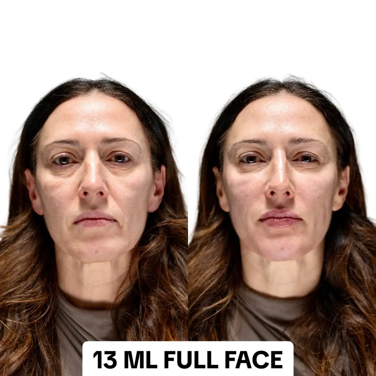 Marta's treatment plan had the following objectives: 1️⃣ Rejuvenate the under eye area 2️⃣ Restore mid-face and cheekbone structure  3️⃣ Straighten the nose bridge and lift the tip 4️⃣ Diminish the appearance of shadows in the nasolabial folds and marionette lines 5️⃣ Create a harmonious look by addressing the chin projection  6️⃣ Posterior volume restoration focusing on the temples and the area in front of the ear  7️⃣ Enhance the lip shape by adding volume and definition  #dermalfiller #liquidfacelift #naturalfiller #cheekfiller #undereyefiller #nosefiller #lipfiller #chinfiller 