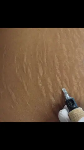 #stretchmarks #streachmarksremoval #الرياض #جدة #أبها #الكويت #اكسبلور #riyadh #dubai #تشققات_الجسم #jeddah #explore #دبي 