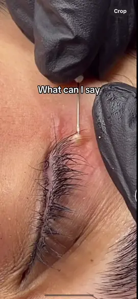 #verysatisfying #whiteheads #extractions 