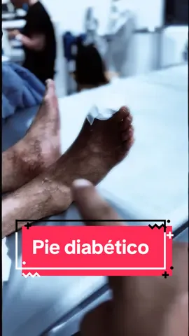 Caso de pie diabético en lunes. Empezó fuerte la semana. #piediabetico #piediabetico😷 #piediabético #insuficienciarenal #hemodiálisis #salvamentodeextremidades #amputacionpierna #cathlablife #cathlablife #angiologia #angiología #cirugíavascularyendovascular #cirugiavascular 