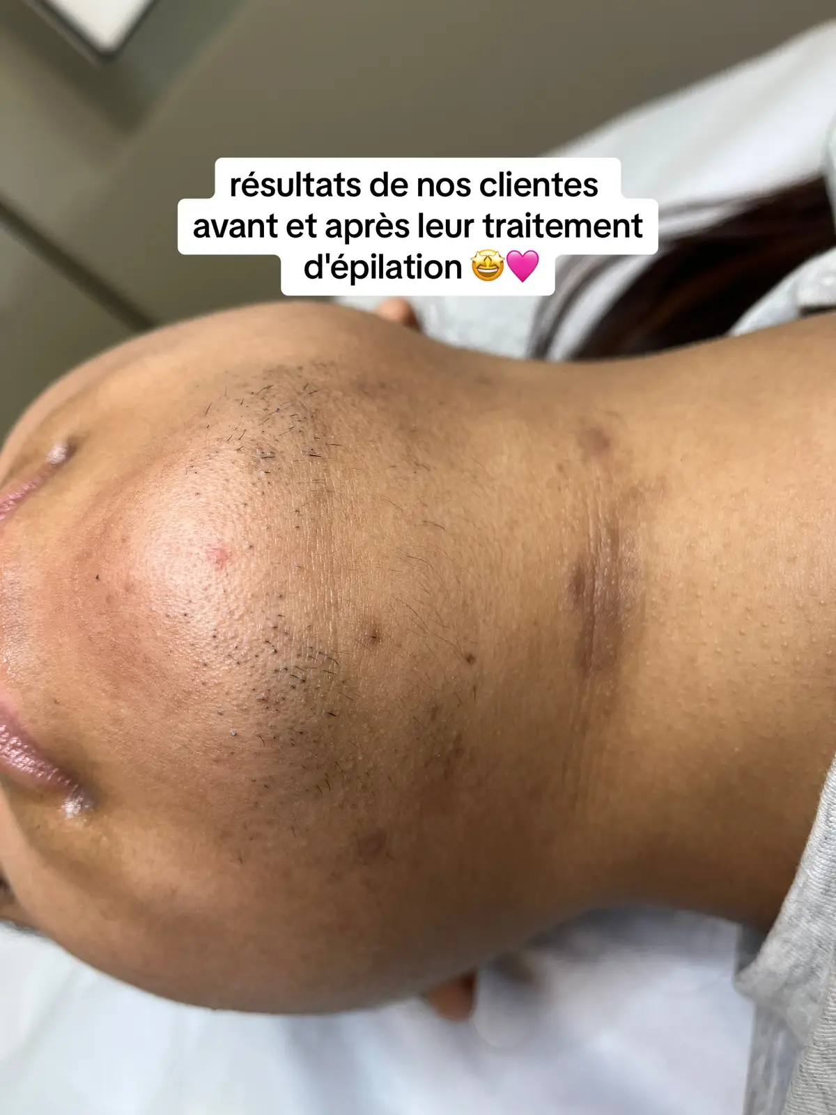 Dites adieu aux poils indésirables et bonjour à une peau lisse et une confiance retrouvée ! Réservez des aujourd'hui votre consultation pour commencer votre aventure vers l'épilation définitive. portable 📞 : 07.45.19.50.18 fixe ☎️ : 09.52.96.21.99 📍28 Avenue de Laumière, Paris, 75019 #BeautyParis #Électrolyse #ÉpilationDéfinitive #PeauLisse #SansPoils #ÉpilationPermanente #SoinsBeauté #BeautéProfessionnelle #ParisBeauty #CentreDeBeauté