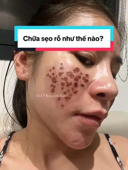 Sẹo rỗ lâu năm bôi thoa đáp ứng kém, can thiệp phải kết hợp đa phương pháp mới cho hiệu quả. Hãy thật sáng suốt và tìm hiểu thật kỹ trước khi quyết định, đừng tin rằng 1 lần là trị được hết nha, nó phải là cả quá trình dài kiên trì bạn nhé! 