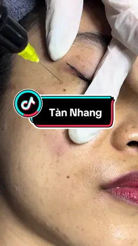 ♻️ ĐIỀU TRỊ TÀN NHANG - ĐỐM NÂU BẰNG PLASMA LẠNH HÀN QUỐC CÓ GÌ KHÁC BIỆT  👉 Nhiệt độ 40*C Không tổn thương da, phục hồi nhanh  👉 Hiệu quả cao, giảm phụ thuộc mỹ phẩm, an toàn cho Làn da châu á 👉 Cold plasma có khả năng tăng sinh collagen và elastin làm đẹp da, và sửa chữa lỗi sai tế bào #Coldplasma  #Dieutrinamtannhang #Simplebeauty  #Chuyengiaocongngheplasma#Simplebeauty  