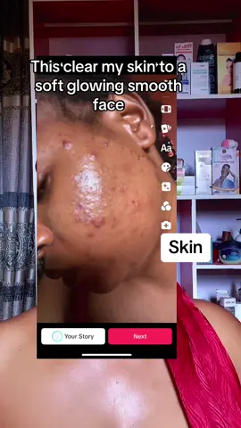 This cleared my skin to a soft glowing skin send message on whats app or instagram to buy skincare #vitaminc #zinc #supplements #acnetreatment #clearskin 