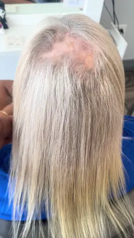 Watch me cover this alopecia spot! #hairtok #viral #salonlife #vlights #hairextensionspecialist #alopecia #balding 