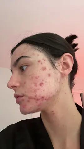 I did it with accutane #accutane#acnejourney#acne#fyp#foryou#nz