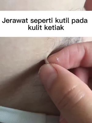 wart removal cream krim penyingkiran ketuat Makes skin smooth Menjadikan kulit licin