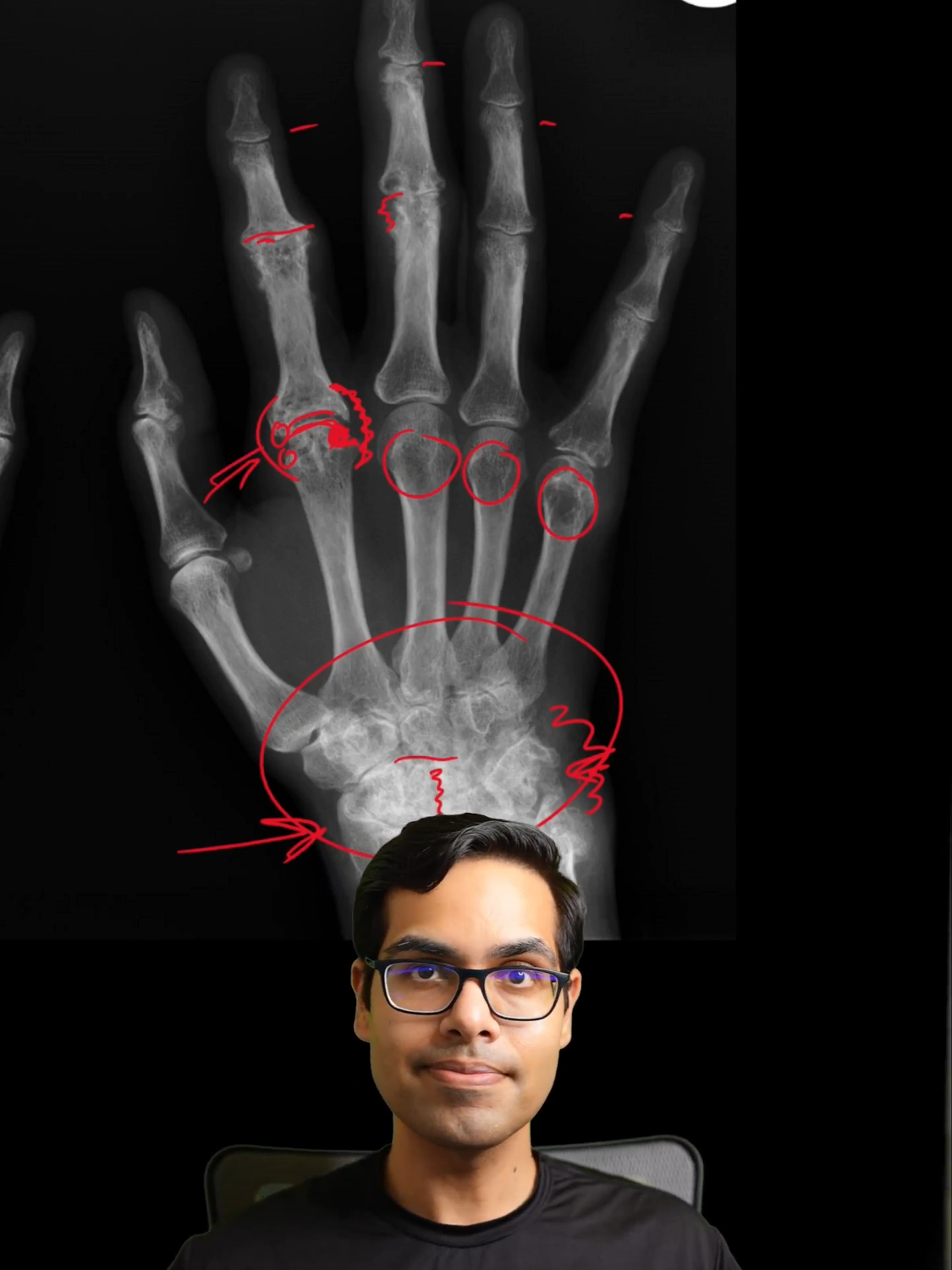 Xray hand - normal vs rheumatoid arthritis. . . . . . #xray #hand #rheumatoidarthritis #osteoarthritis #joints #radiology #doctorsoftiktok #medicaleducation #patienteducation #healthliteracy #rheumatology