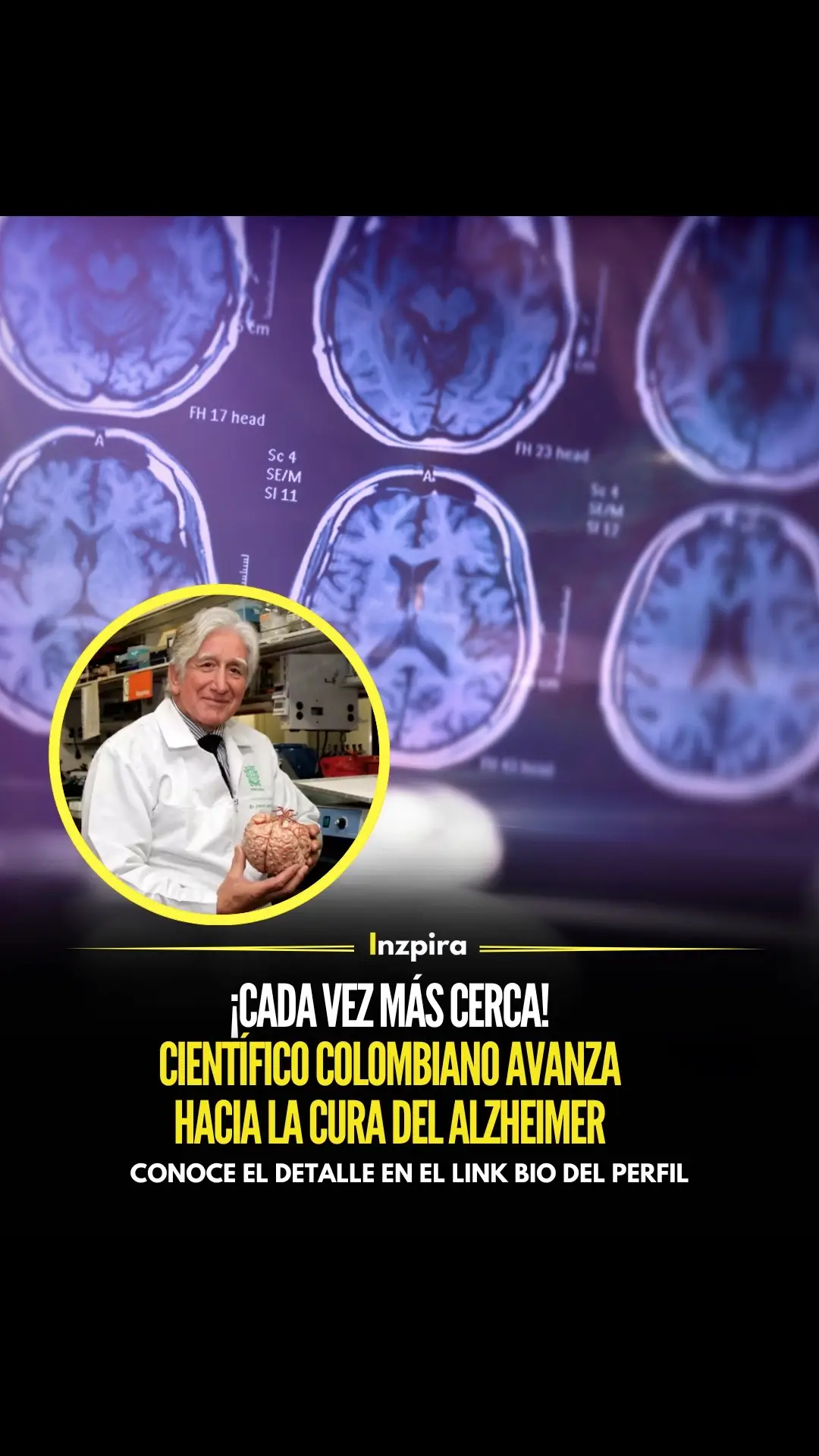 Francisco Lopera, un destacado investigador de Colombia, ha dedicado su vida a buscar respuestas sobre el Alzheimer. En los años 80, Lopera recibió a un paciente con una misteriosa forma de Alzheimer precoz hereditario. Años más tarde, descubrió que la causa era una mutación en el gen de la presenilina 1, conocida como la «mutación paisa». Este hallazgo, junto con la identificación de la mayor población mundial con Alzheimer genético, le valió el prestigioso premio Potamkin, considerado el “Nobel” de la investigación sobre el Alzheimer. ✅ Conoce el detalle en el link bio del perfil.  • • • #Alzheimer #Enfermedad #Cura #Doctor #Colombia 