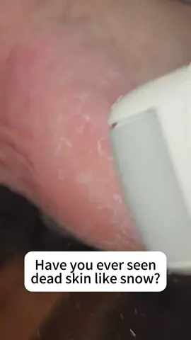 To get baby-like feet, follow what I say!