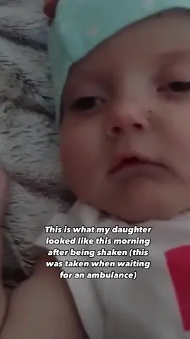 This is what my daughter looked like before and after shaken baby syndrome. 