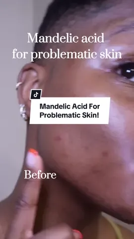 I was gifted by By Wishtrend their Supple Preparation Unscented Toner , and I truly wish i started using Mandelic Acid sooner! Its a great exfoliant for acne prone/ problematic skin that does not dry out your skin. It helps Regulate sebum production, hyperpigmentation and is a great treatment for acne @bywishtrend.us #mandelicacid #koreanskincare #gifted_by_bywishtrend #acneproneskin #bywishtrend #mandelicacid #chemicalexfoliant #sensitiveskin #koreanskincare #gentleskinrenewal 