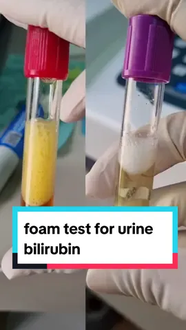 bilirubin in urine #labtest #bilirubin #liverdisease #liver #pigment #medtech 