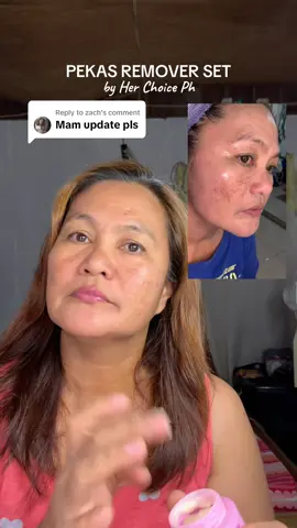 Replying to @zach pang 20 days ni mama ng paggamit nitong Her choice pekas remover set, so far nababawasan naman na po yung pekas niya and nag lighten na yung mukha niya. Tuloy tuloy niya pa hanggat mawala na talaga yung pekas 🥰 #pekasremover #pekasremovercream #pekasremoverset #herchoiceph #herchoice 