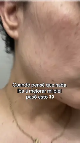 Justo cuando pense que nada iba a mejorar mi piel encontre los productos que en menos de un mes transformarin mi piel 🤯 Solo empeze con dos productos! Un suero para la cara y crema.  Estos productos tienen el ingrediente de el elixir de la planta de olivo.  Si estás interesada comenta “INFO” y te mando mensaje privado 🫶🏼 #antesydespues #manchasenlapiel #manchasenlacara #skincareroutine 