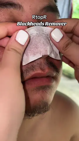 rtopr mango blackheads remover Grabe effective guys blackheads no more talaga 😭🫶  #rtoprwhiteheadsremover #rtoprmango #blackheadsandwhiteheads 