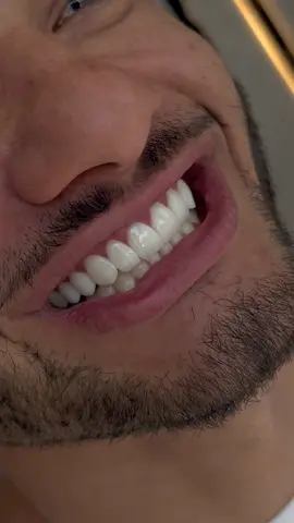 Alguem acerta a cor ? Escreve aqui !!  #viral #foryou #ViralCut #trend #sorriso #antesedepois #lentesemresina #lentesemresinacomposta 