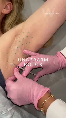 This one’s for all the hyperhidrosis girlies!  Underarm Botox for excessive sweating is a major key, especially this time of year.  #armpit #botoxcheck #botox #medspalife #njmedspa 