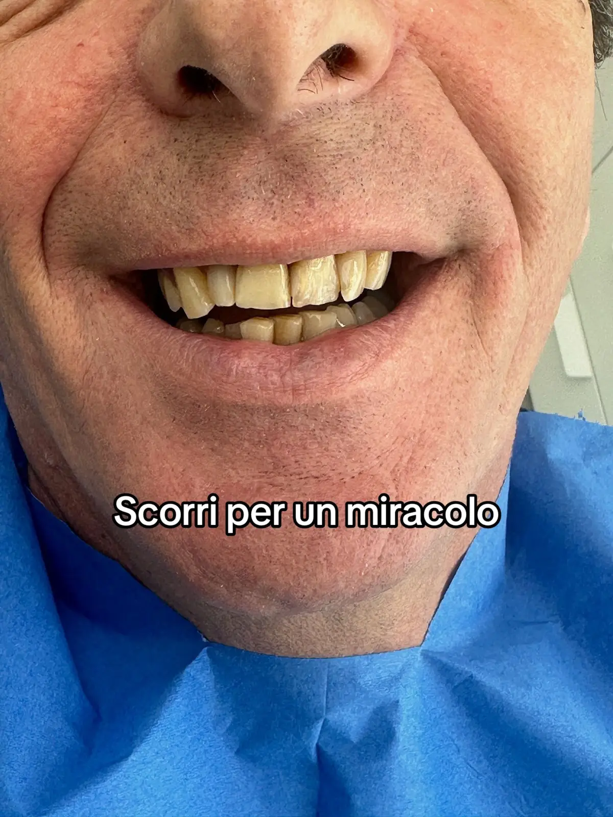 In poche parole ho cambiato la sua vita in meno di due ore 🤷🏽‍♂️🦷 #faccettedentali #faccette #clienti 