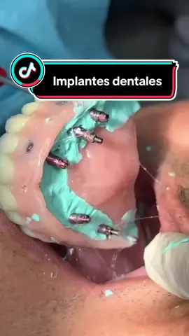 Protesis sobre implantes 🦷 Dirección : san Isidro / Lima /Peru 📲escríbenos al WhatsApp de citas y consultas +51 942836990 para enviarte la información, consultas previa cita  #implantes #implantesdentales #implants #implantedental #protesis #protesisdental #protesisremovible #protesistotal #fy #fyp #fypage #foryoupage #limaperu🇵🇪 #lima #peru🇵🇪 #tendencia #viral #dentis #dentista #dentistatiktok #tiktok #odontologia #odontologo #Recuerdos #protesisdental 